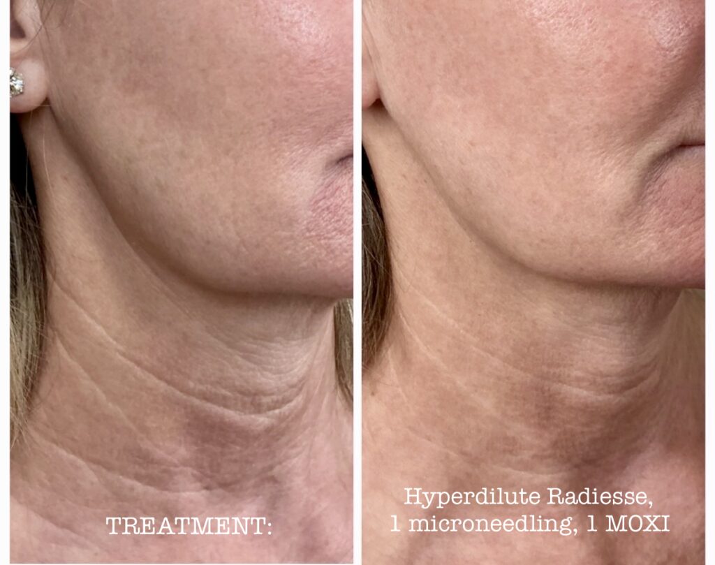Before and After Image: Hyperdilute Radiesse, 1 microneedling, 1 MOXI - front