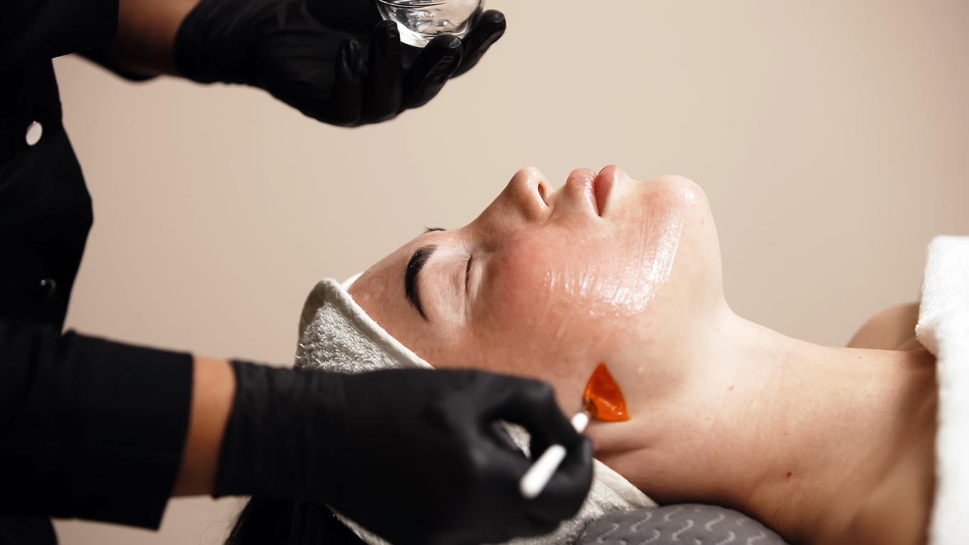 Chemical peel being applied to improve acne scars.